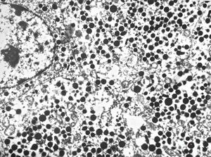 F, 72y. | carcinoid … metastasis to lymphonode F, 72y. | carcinoid … metastasis to lymphonode